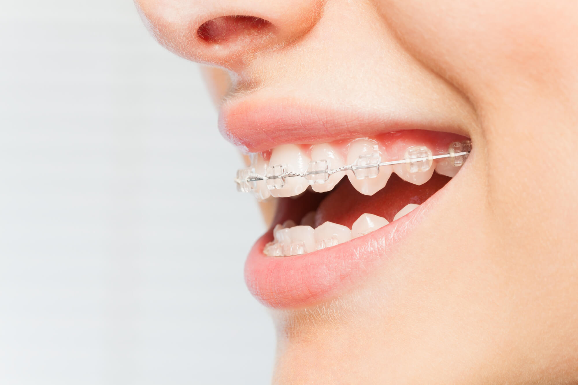 Love Your Smile: The Best Teeth Straightening Options for Adults - Ello ...