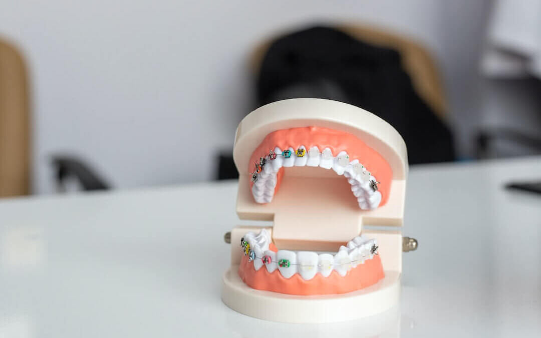 What Is the Cost of Braces and Are There Payment Plans Available?
