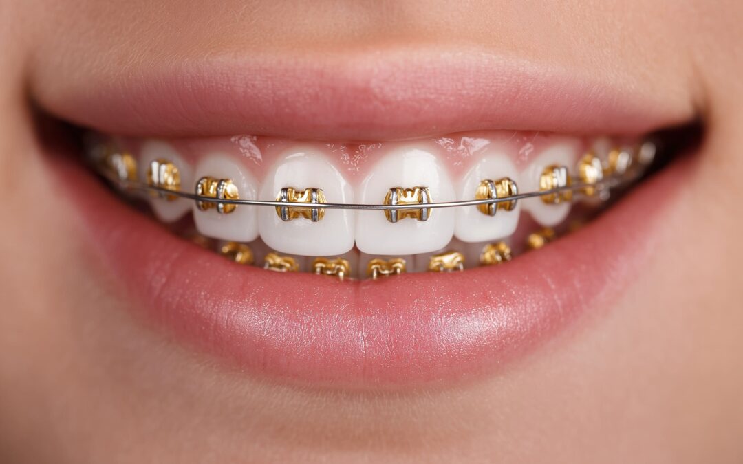Gold braces near Pearland tx